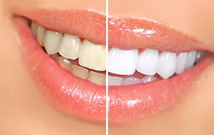 Teeth Whitening Before and After